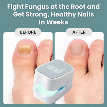 Mavriy™ - Nail Fungus Laser Device