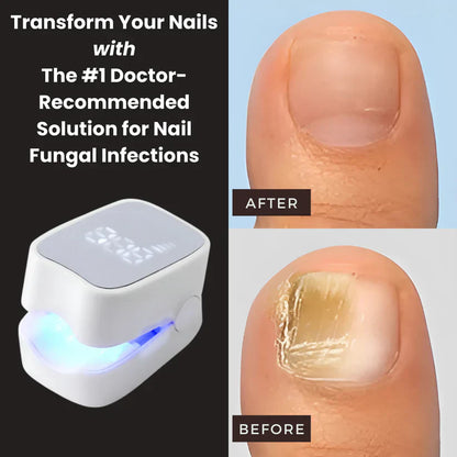 Mavriy™ - Nail Fungus Laser Device